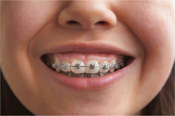 Traditional Braces in Fort Worth