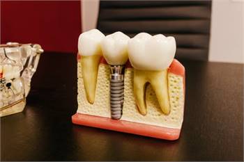 Dental Implants Dallas, TX - Affordable Dentist Near Me of Dallas